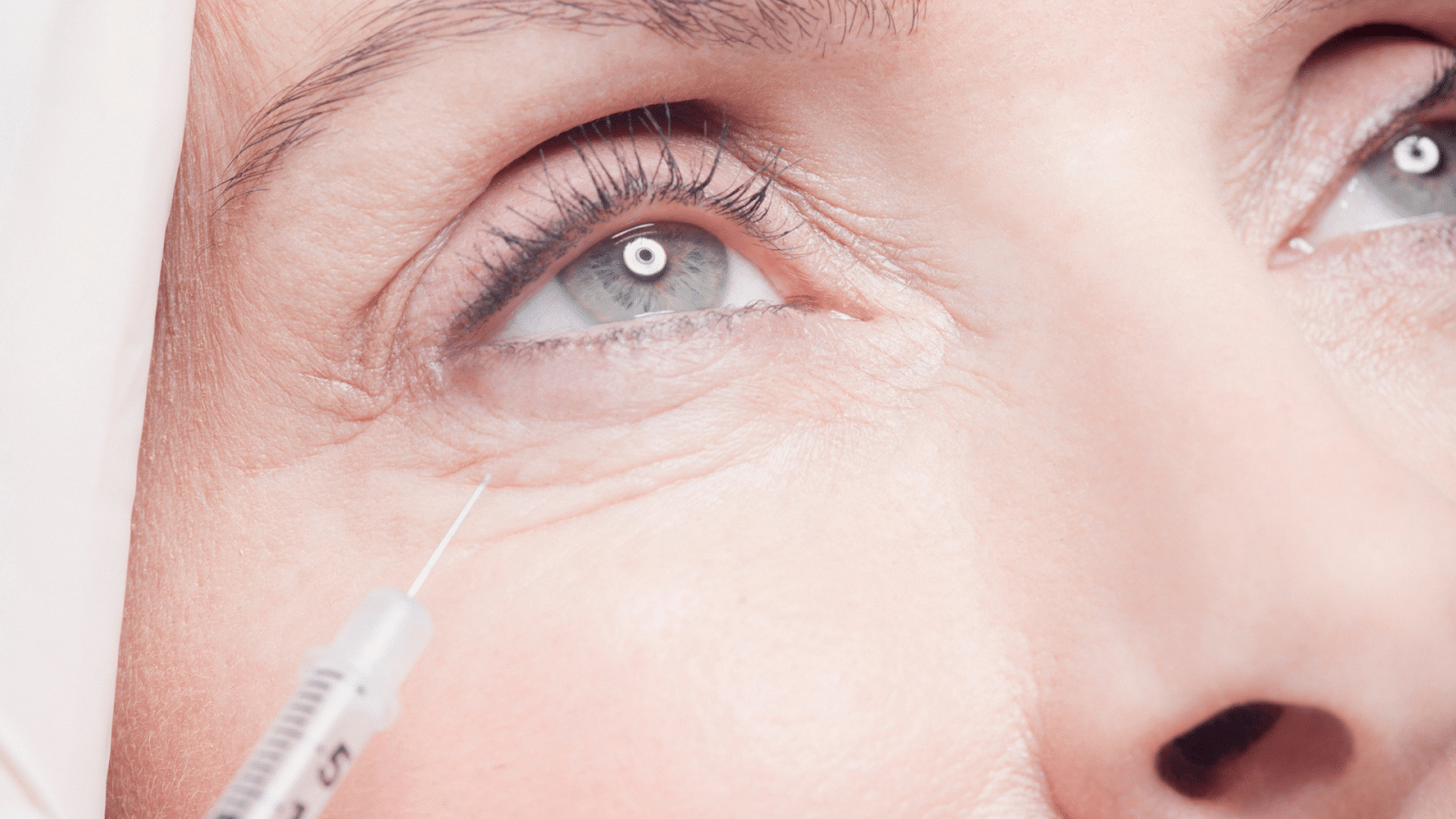 belotero filler under eyes